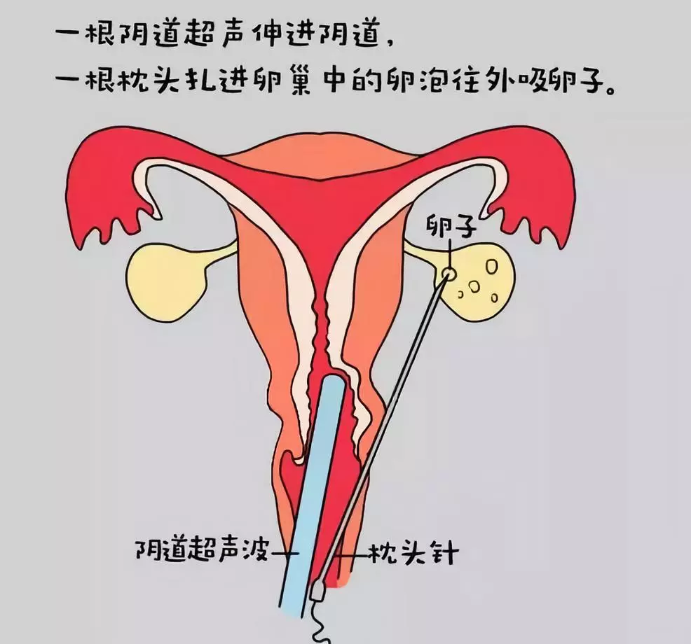 高龄孕育风险大，做试管也得趁早~